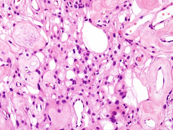 2B6 Meningioma, (Case 2) H&E 9.jpg