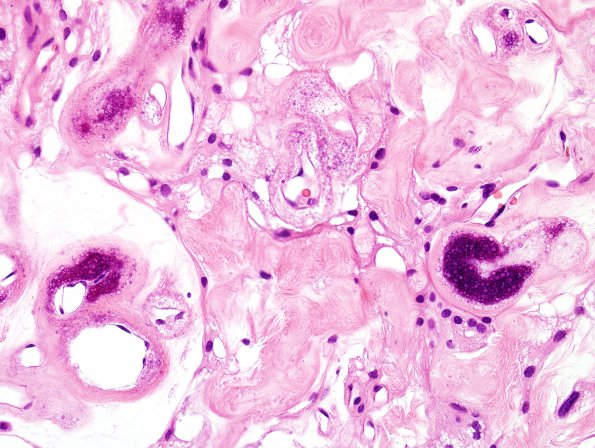 2B7 Meningioma, (Case 2) H&E 8.jpg