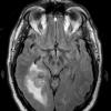 3A1 Meningioma, angiomatous (Cage 3) FLAIR - Copy