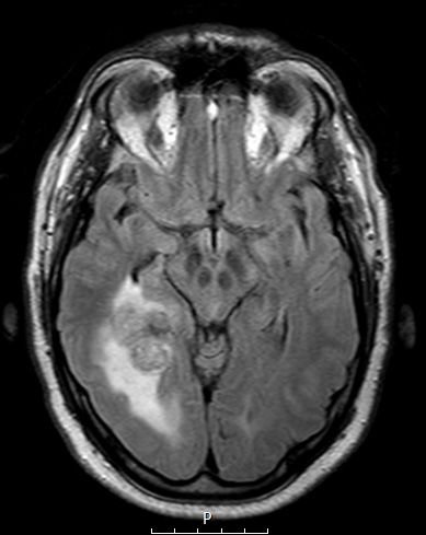 3A1 Meningioma, angiomatous (Cage 3) FLAIR - Copy