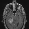 3A2 Meningioma, angiomatous (Case 3) T1W - Copy