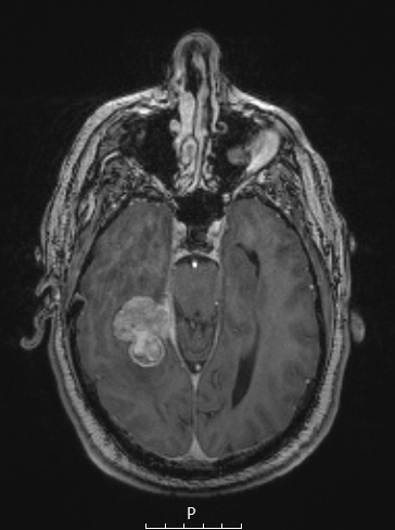 3A2 Meningioma, angiomatous (Case 3) T1W - Copy