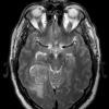 3A3 Meningioma, angiomatous (Case 3) T2 2 - Copy