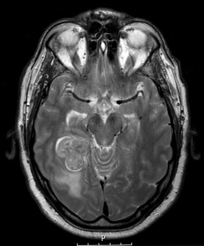 3A3 Meningioma, angiomatous (Case 3) T2 2 - Copy