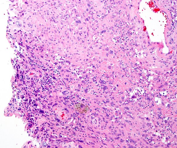 3B1 Meningioma, angiomatous (Case 3) H&E-3