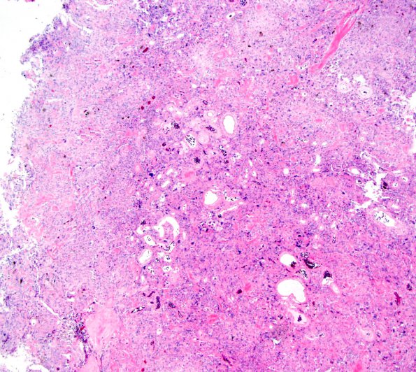 3B2 Meningioma, angiomatous (Case 3) H&E-5