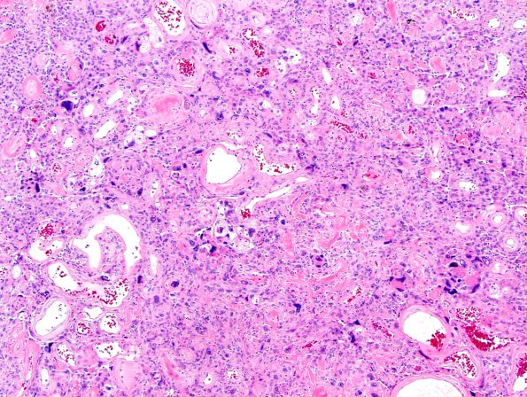 3B3 Meningioma, angiomatous (Case 3) H&E-6