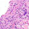 3B4 Meningioma, angiomatous (Case 3) H&E-1