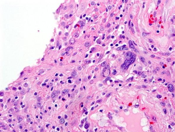 3B4 Meningioma, angiomatous (Case 3) H&E-1