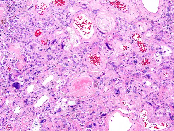 3B5 Meningioma, angiomatous (Case 3) H&E-7