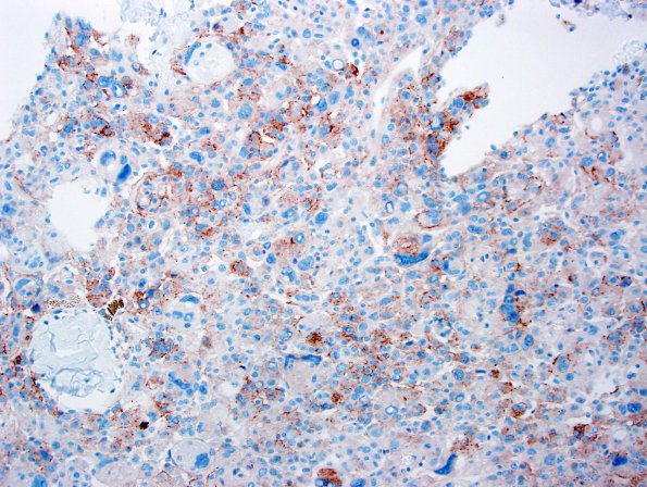 3C Meningioma, angiomatous (Case 3) EMA-1