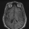 4A1 Meningioma, angiomatous (Case 4) T1noC - Copy