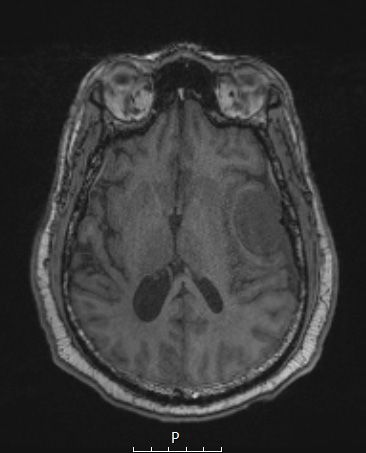 4A1 Meningioma, angiomatous (Case 4) T1noC - Copy