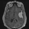 4A2 Meningioma, angiomatous (Case 4) T1W - Copy