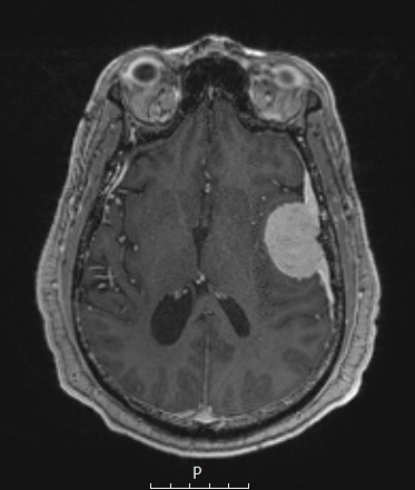 4A2 Meningioma, angiomatous (Case 4) T1W - Copy