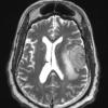 4A3 Meningioma, angiomatous (Case 4) T2W - Copy