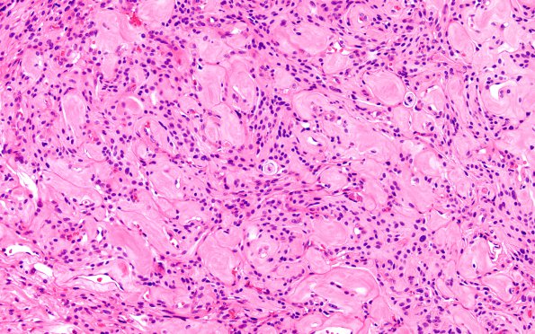 4B3 Meningioma, angiomatous (Case 4) H&E 1