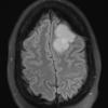 5A1 Meningioma, angiomatous and microcystic (Case 5) FLAIR - Copy