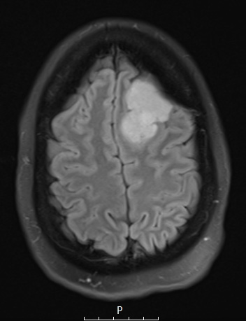 5A1 Meningioma, angiomatous and microcystic (Case 5) FLAIR - Copy