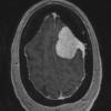 5A2 Meningioma, angiomatous and microcystic (Case 5) T1W - Copy