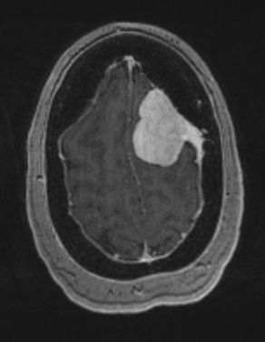 5A2 Meningioma, angiomatous and microcystic (Case 5) T1W - Copy