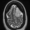 5A3 Meningioma, angiomatous and microcystic (Case 5) T2W - Copy