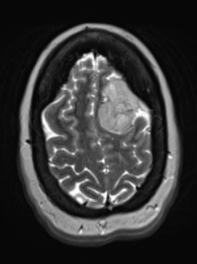 5A3 Meningioma, angiomatous and microcystic (Case 5) T2W - Copy