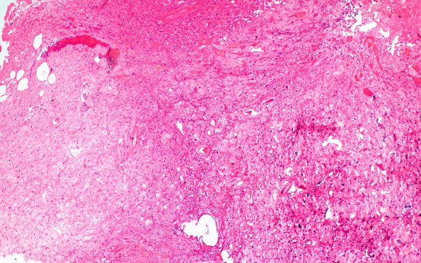 5B1 Meningioma, angiomatous and microcystic (Case 5) H&E 4