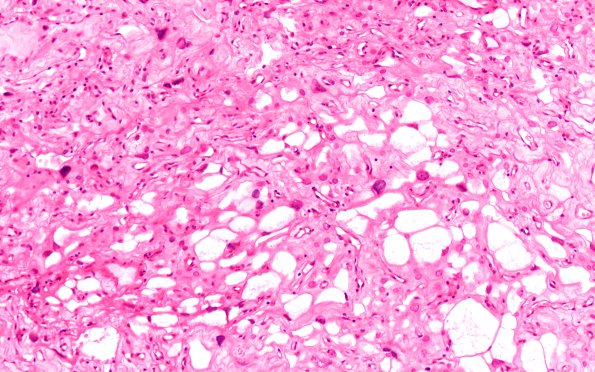 5B3 Meningioma, angiomatous and microcystic (Case 5) H&E 7