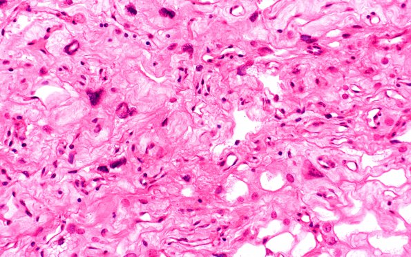 5B4 Meningioma, angiomatous and microcystic (Case 5) H&E 2