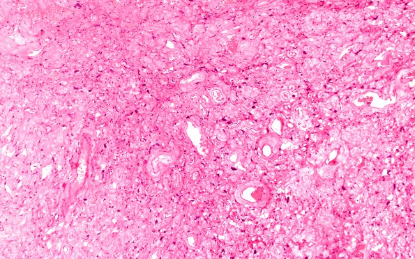 5B5 Meningioma, angiomatous and microcystic (Case 5) H&E 1