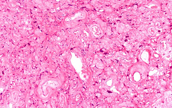 5B6 Meningioma, angiomatous and microcystic (Case 5) H&E 3