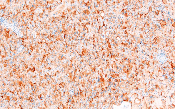 5C1 Meningioma, angiomatous and microcystic (Case 5) EMA 1