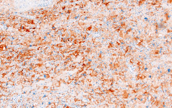 5C2 Meningioma, angiomatous and microcystic (Case 5) EMA 2