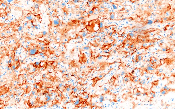 5C3 Meningioma, angiomatous and microcystic (Case 5) EMA 3