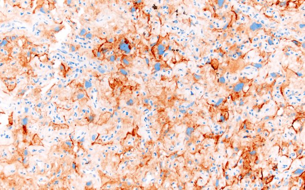 5C4 Meningioma, angiomatous and microcystic (Case 5) EMA 4