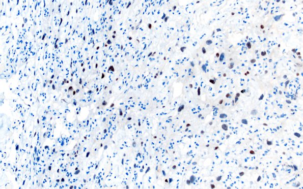 5D Meningioma, angiomatous and microcystic (Case 5) PR 1