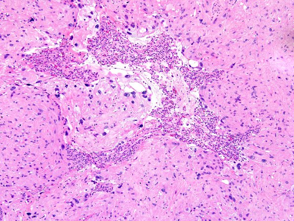 6A1 Meningioma, angiomatous, xanthomatous (Case 6) H&E 5.jpg