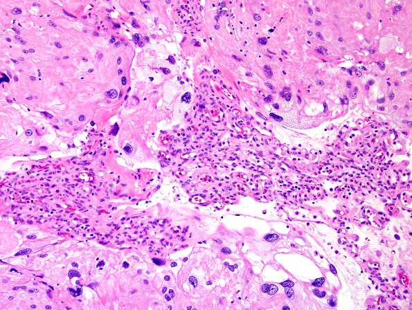 6A2 Meningioma, angiomatous, xanthomatous (Case 6) H&E 3.jpg