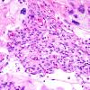 6A3 Meningioma, angiomatous, xanthomatous (Case 6) H&E 4.jpg