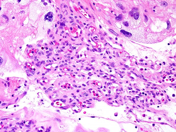 6A3 Meningioma, angiomatous, xanthomatous (Case 6) H&E 4.jpg