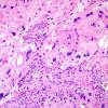 6A4 Meningioma, angiomatous, xanthomatous (Case 6) H&E 6.jpg