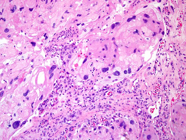 6A4 Meningioma, angiomatous, xanthomatous (Case 6) H&E 6.jpg