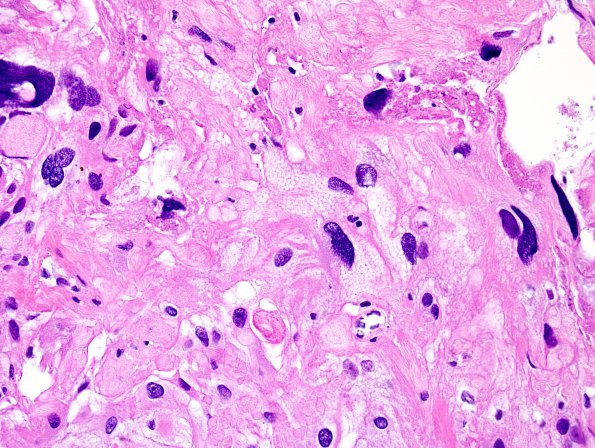 6A5 Meningioma, angiomatous, xanthomatous (Case 6) H&E 2.jpg