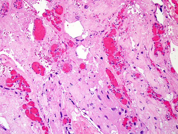 6A6 Meningioma, angiomatous, xanthomatous (Case 6) H&E 18.jpg