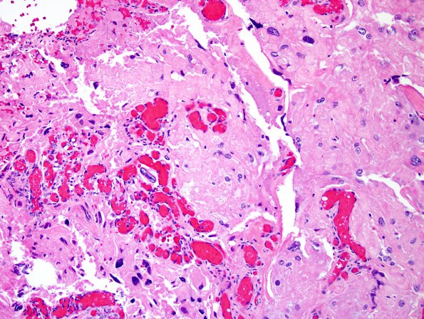 6A7 Meningioma, angiomatous, xanthomatous (Case 6) H&E 19.jpg