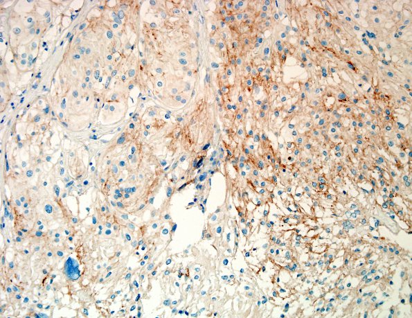 6B1 Meningioma, angiomatous, xanthomatous (Case 6) EMA 2.jpg