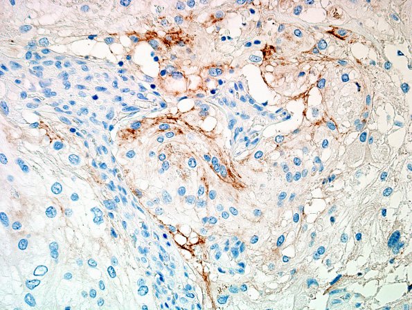 6B2 Meningioma, angiomatous, xanthomatous (Case 6) EMA 3.jpg