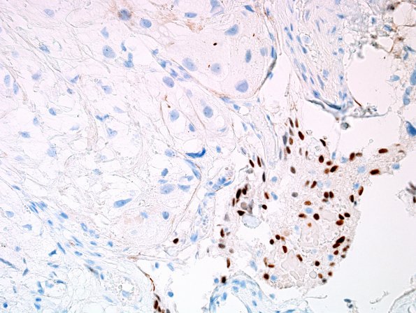 6C1 Meningioma, angiomatous, xanthomatous (Case 6) PR 1.jpg