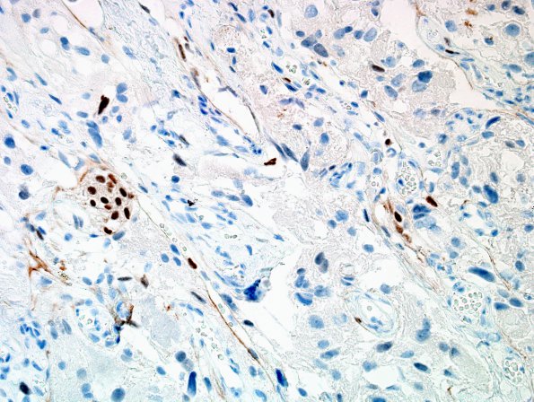 6C2 Meningioma, angiomatous, xanthomatous (Case 6) PR 6.jpg